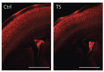 Image: Forebrain of a mouse genetically engineered to express the mutated gene that causes Timothy Syndrome (TS) shows fewer neurons contributing to a brain structure responsible for long-distance communications between the left and right hemispheres, called the corpus callosum, compared to the same structure in a control animal (Ctrl). Human iPSCs from TS patients showed a similar reduction (Photo courtesy of Ricardo Dolmetsch, PhD, Stanford University).